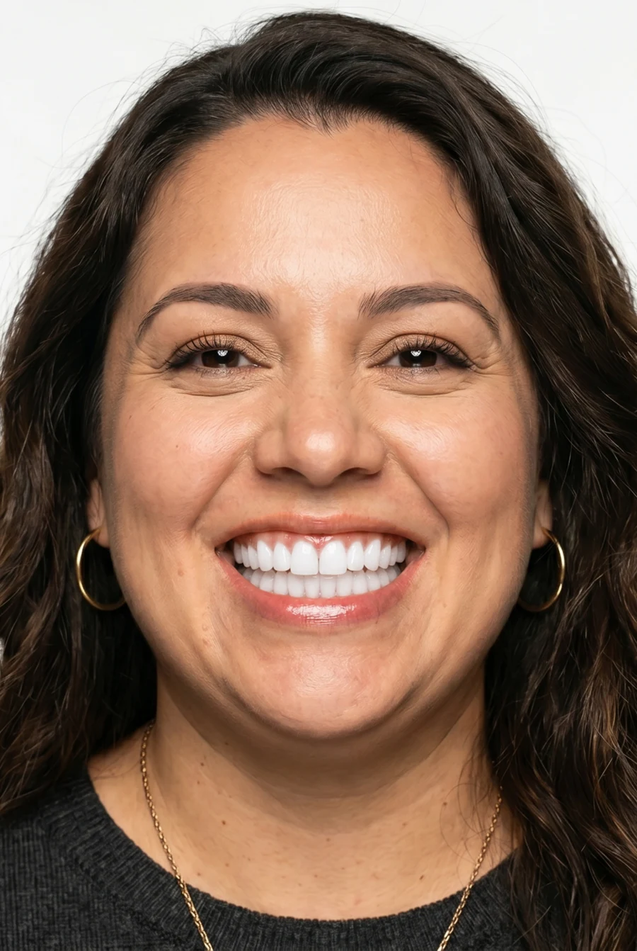 After — with porcelain veneers