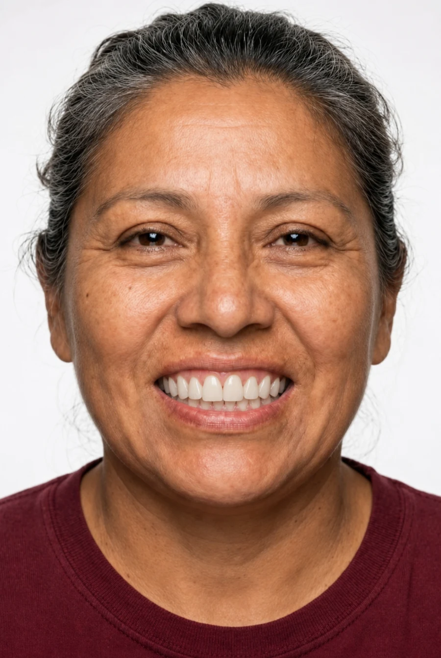 After — with porcelain veneers